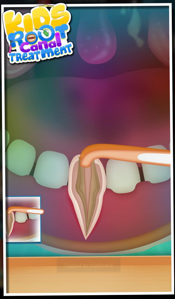 Root Canal Treatment